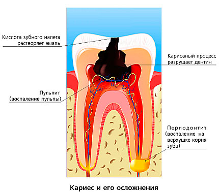 Лечение пульпита и периодонтита