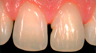 нанопокрытие зубов диастема и дефект