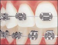 исправление прикуса брекетами